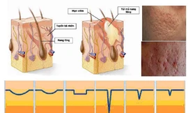 Nguyên nhân gây viêm nang lông
