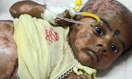 Em bé 3 tháng tuổi tự bốc cháy bí ẩn