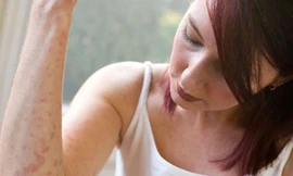 Thuốc vườn nhà chữa bệnh 'giời leo'