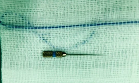 Kim nha khoa dài 4cm được các bác sĩ lấy ra thành công