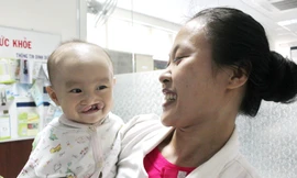 Dự kiến 300 trẻ bị khe hở môi, vòm miệng sẽ được phẫu thuật miễn phí trong tháng 10. 