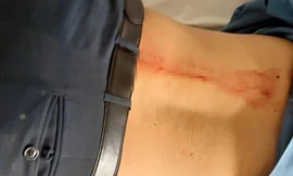 Anh Bình đang điều trị tại bệnh viện Đa khoa tỉnh Đắk Nông với vết thương sau lưng