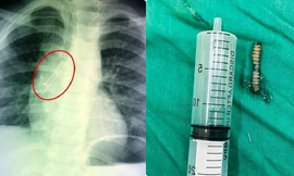 Mở quả trứng đồ chơi, bé trai bị lò xo bắn vào phổi