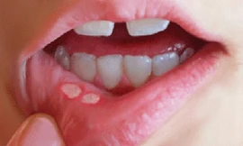 Ung thư ngỡ chỉ là nhiệt miệng, người đàn ông phải cắt cả góc má