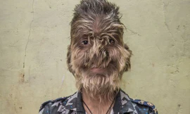 Uống nhầm thuốc, nhiều trẻ em Tây Ban Nha mắc 'hội chứng người sói'