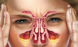 Tự trị viêm xoang ở nhà hiệu quả với 5 cách đơn giản