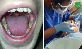 Nghiện nước tăng lực, chàng trai bị mục nát hàm răng