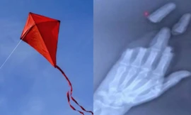 Người đàn ông mất 3 ngón tay vì thả diều