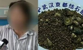 Nhịn ăn sáng nhiều năm, bụng người phụ nữ chứa 7.750 viên sỏi mật