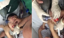 Căng não bác sĩ cứu bé trai ngưng tim ngưng thở vì hóc thạch rau câu