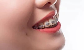 Tại sao bạn chấp nhận chi hàng chục triệu đồng để niềng răng?