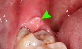 Không nhổ răng khôn vào những thời điểm sau để tránh các biến chứng về sau