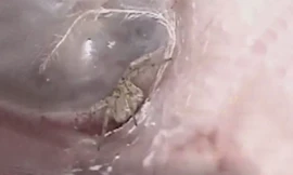 Nhện giăng tơ trong tai chàng trai trẻ