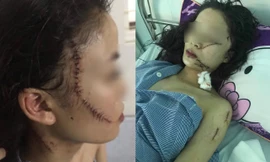 Toàn cảnh thiếu nữ 18 tuổi bị 3 cô gái đánh đập, rạch mặt giữa đêm