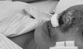 Người phụ nữ ở Hà Nội bị 'vi khuẩn ăn thịt người' ăn mũi