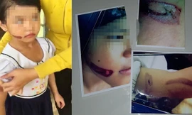 Vết thương ở tay và mặt bé T.