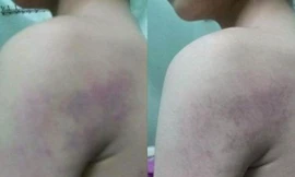 Tin ‘hot’ giáo dục: Đánh học sinh thâm tím người, cô giáo nói gì?