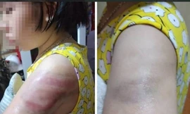 Nam Định: Giáo viên đánh học sinh tím người vì viết bài chậm