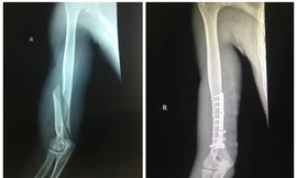 Chơi vật tay với bạn, thanh niên 19 tuổi bị gãy xương cánh tay