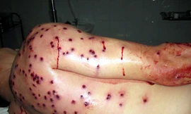 Bị bắn 100 viên đạn hoa cải vì... can đánh nhau