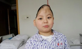 Phẫu thuật thành công cho cậu bé 'nửa đầu'