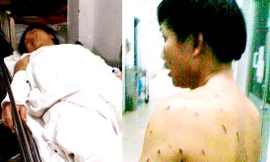 Tạt axít làm chín người trọng thương vì bị từ hôn