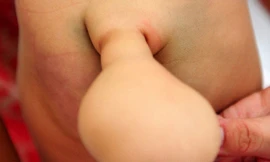 Kỳ lạ bé trai 7 tháng tuổi mọc đuôi