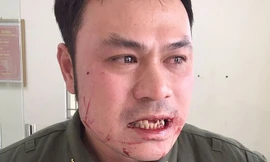 Nhân viên an ninh sân bay Nội Bài bị cò mồi taxi đánh gãy 4 răng