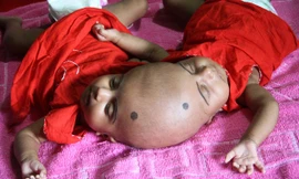 Cặp chị em song sinh dính liền đầu Rabia và Rukia.