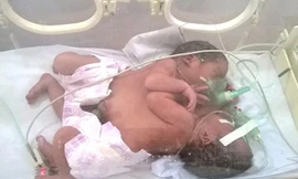 Cặp song sinh dính liền khi được điều trị tại Bệnh viện Việt Đức.