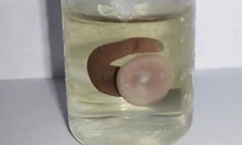 Con vắt dài 3 cm sống trong mũi chàng trai trẻ