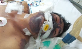 Liên cầu lợn có trong tiết canh, thịt lợn chưa nấu chín có thể gây bệnh cảnh trầm trọng cho người bệnh. Trong ảnh, bệnh nhân nhiễm khuẩn huyết đe dọa tính mạng do liên cầu lợn gây ra. Ảnh: T.A.