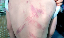 Học sinh bị bố quất roi điện đa chấn thương được xuất viện