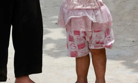 Cô bé ba tuổi có bàn chân khổng lồ