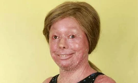 Cô gái có làn da vảy cá