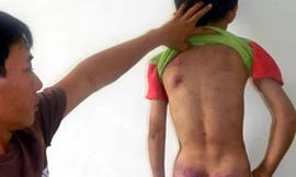 Cha bị bắt vì đánh con chín tuổi nhập viện