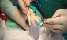 Cần Thơ: Bị bò đá, nam thanh niên phải cắt một bên tinh hoàn