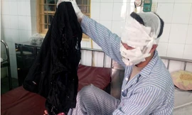 nh Đ. bị bỏng kín mặt và 2 tay. Chiếc áo khoác anh mặc cũng bị cháy.