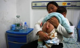 Bé 5 tháng tuổi mọc đuôi dài hơn 12cm