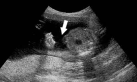 Thai nhi trong bụng cụ bà 76 tuổi