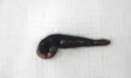  Con vắt "làm tổ" trong hốc mũi của trẻ 2 tuổi gần 10 ngày mới được gắp ra.