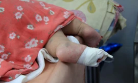 Hàng chục trẻ bị lây sởi ngay tại bệnh viện