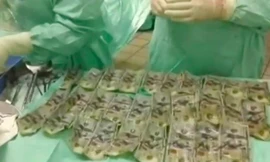 Số tiền mệnh giá 100 USD lấy từ dạ dày và ruột của nữ bệnh nhân Colombia.