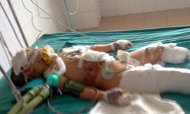 Cháu bé nạn nhân vụ nổ xe máy đang nguy kịch