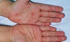 Virus gây tay chân miệng chưa biến đổi độc lực