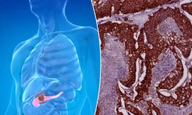 Tỷ lệ tử vong vì ung thư tuyến tụy tăng nhanh ở phụ nữ dưới 55 tuổi
