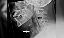 Người đàn ông bị rách khí quản vì nhịn hắt hơi 
