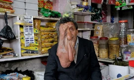 Người đàn ông có bộ mặt chảy xệ lạ kỳ, một căn bệnh hiếm gặp 