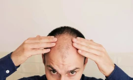 Tại sao đàn ông hay bị hói ở đỉnh đầu và cách chữa trị 