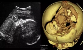 Thực hiện ca phẫu thuật não đầu tiên với thai nhi trong bụng mẹ 